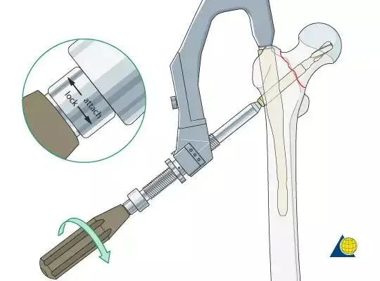 股骨粗隆间骨折pfna内固定核心技术操作步骤标准化流程