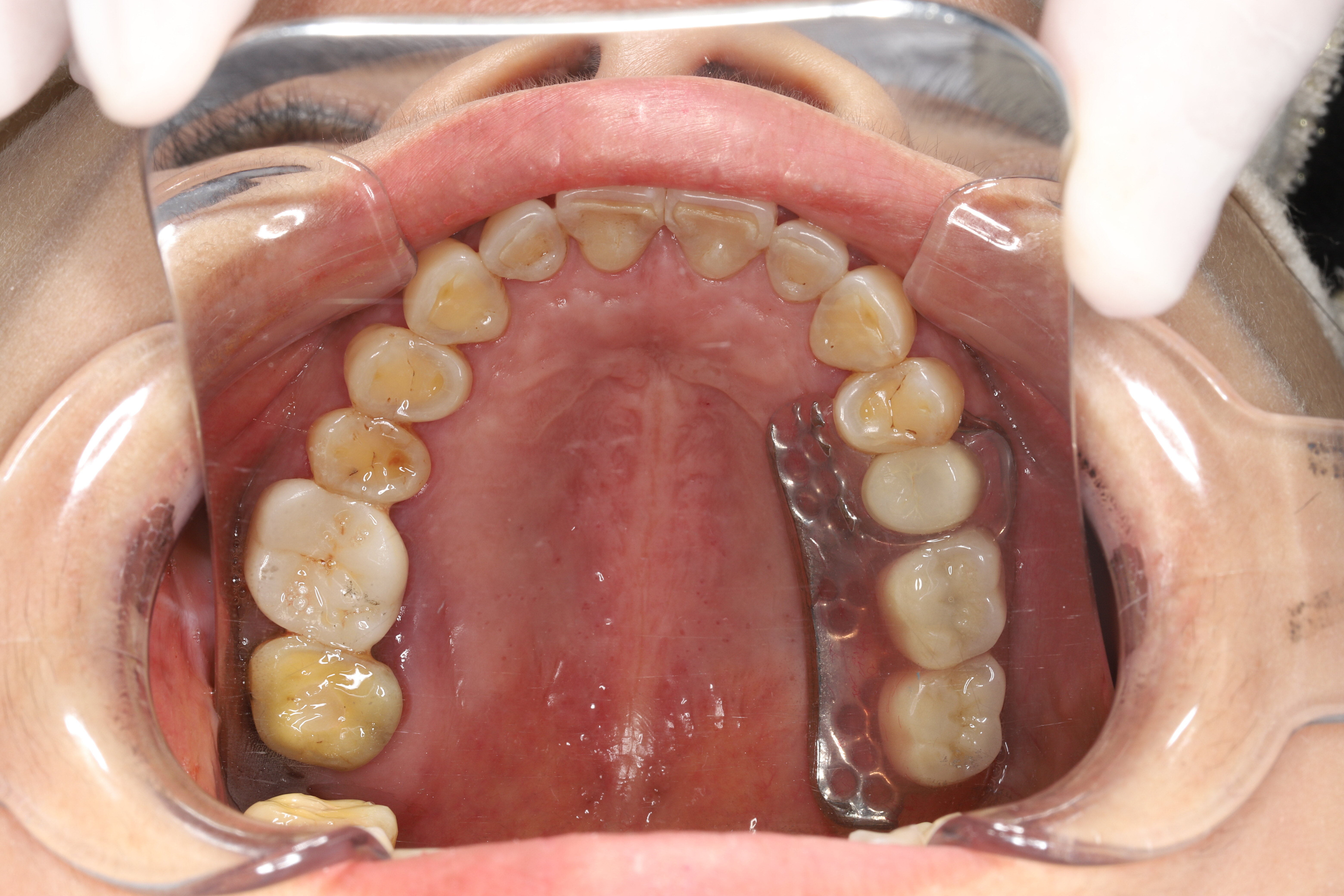 无牙颌或远端游离缺失的微创修复 
