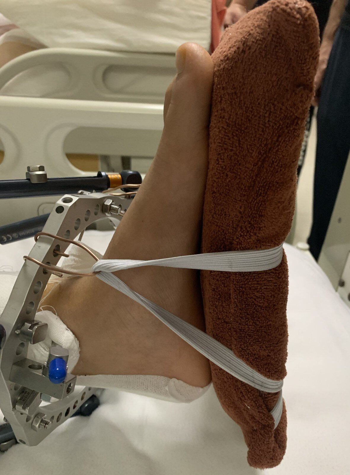 积水潭足踝外科杜辉医生患者外固定架术后注意事项_先天性足畸形_治疗