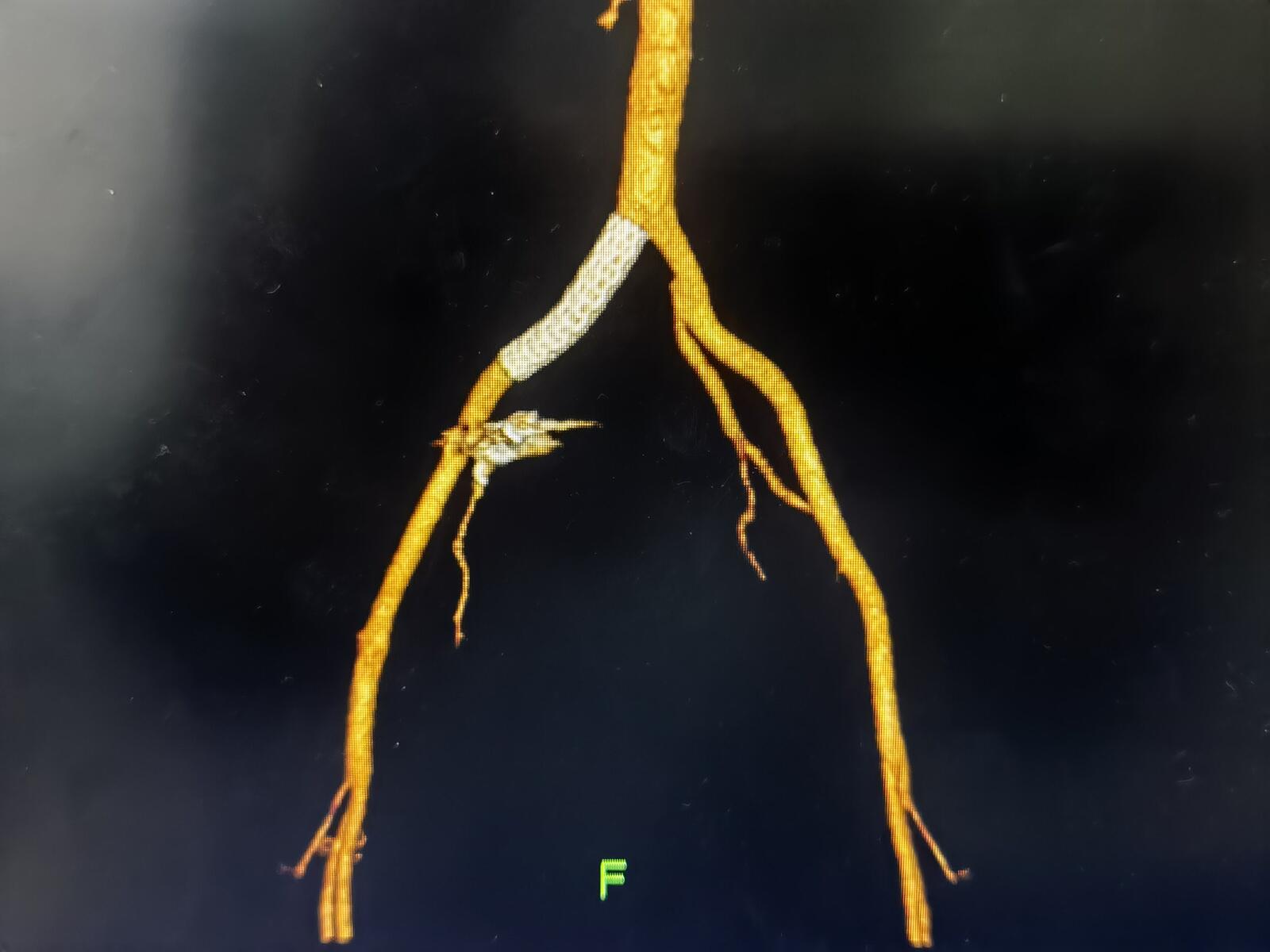 髂血管位置图图片