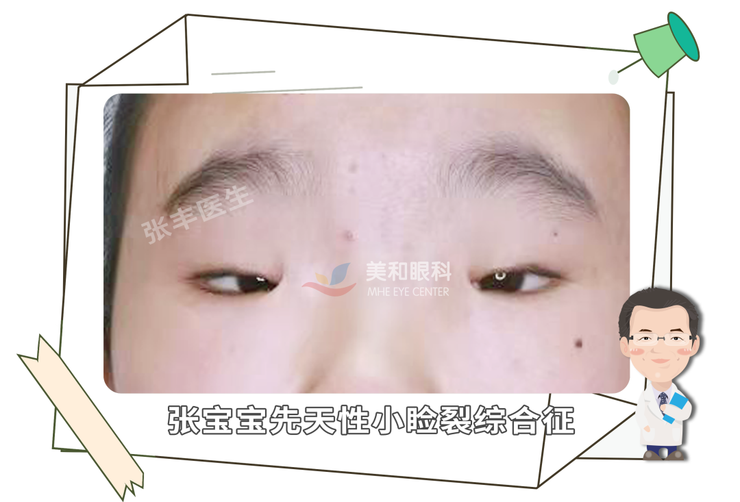 小睑裂综合征漫漫求医路_小睑裂_小睑裂治疗方式 - 好大夫在线