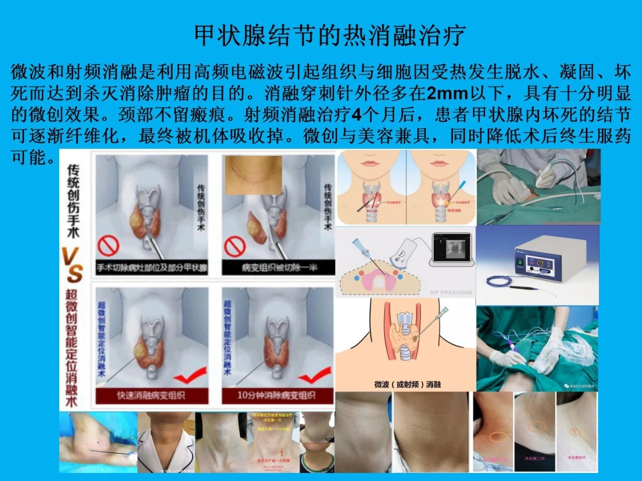 颈部无瘢痕甲状腺手术技术 - 好大夫在线