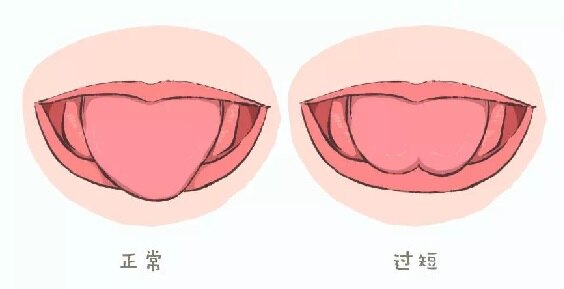 舌系带过短的照片图片