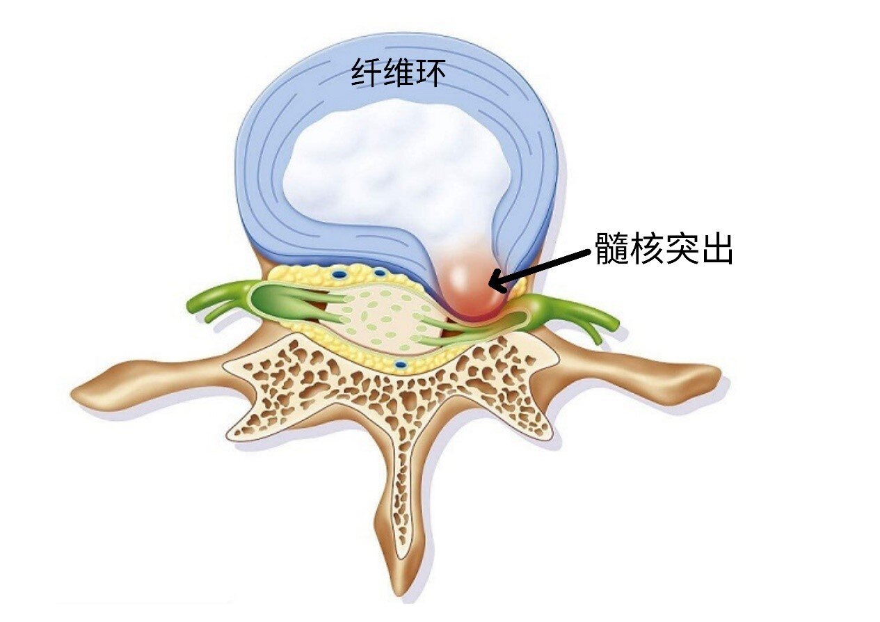 髓核凸出图片