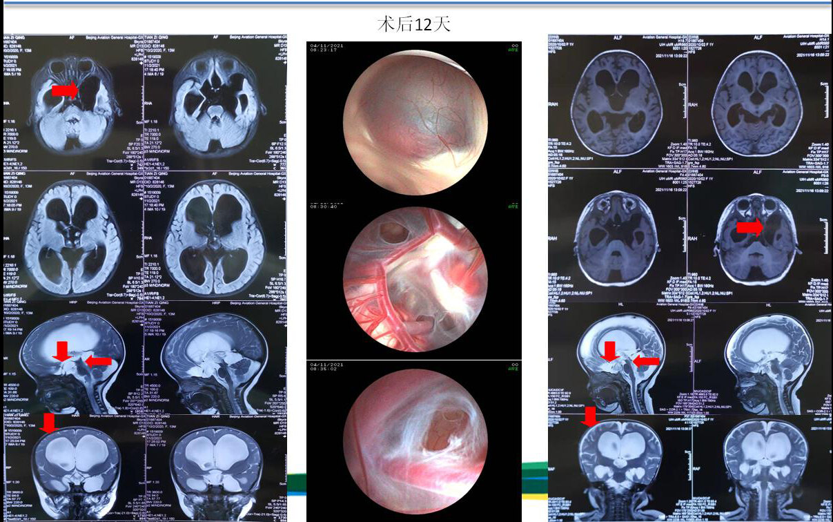 鞍上池囊腫合併雙側顳極蛛網膜囊腫相關性腦積水一例 - 好大夫在線