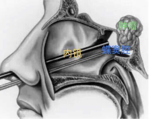 泌乳素prl型垂体瘤的临床表现诊断及治疗