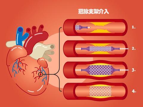 冠脉支架植入手术会有出现一定的并发症.