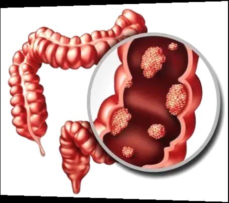 指的是来源于结肠和直肠黏膜的恶性肿瘤,包括升结肠,横结肠,降结肠