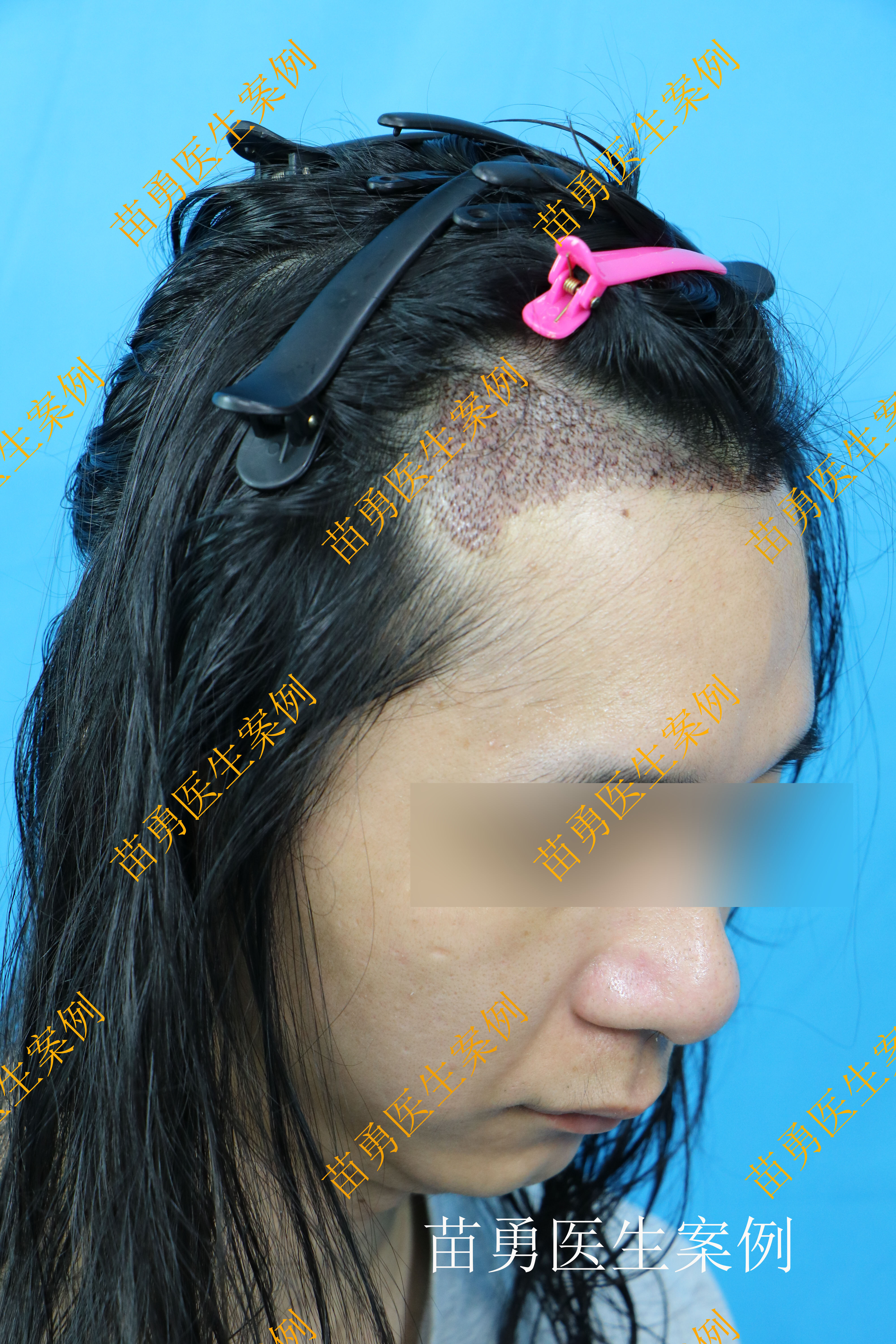 【植发案例3|男性额角】_植发_植发治疗介绍 - 好大夫在线