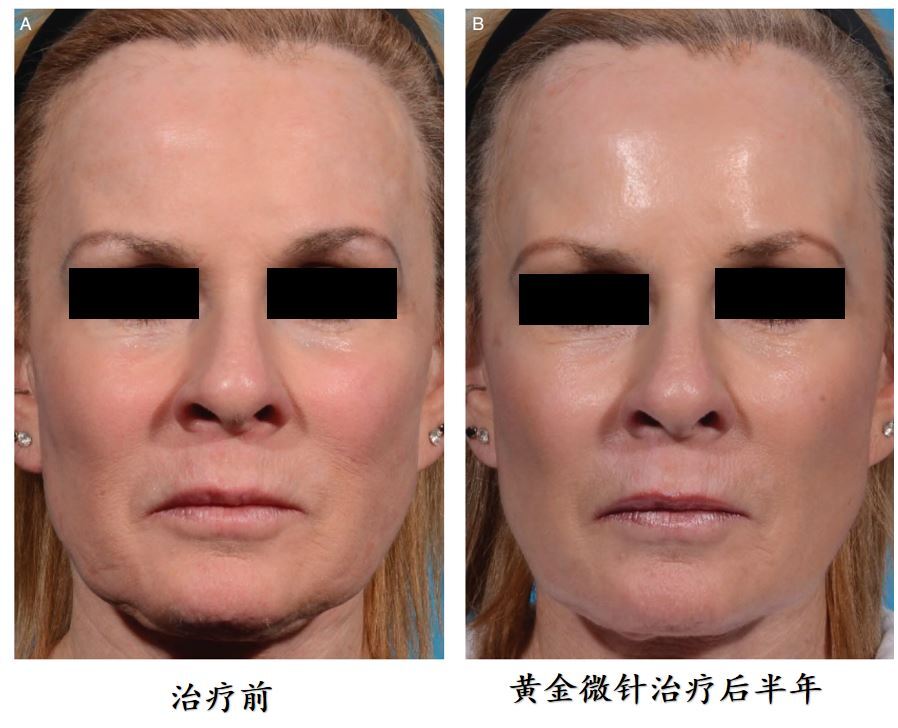 皮肤松弛治疗前后对比.jpg