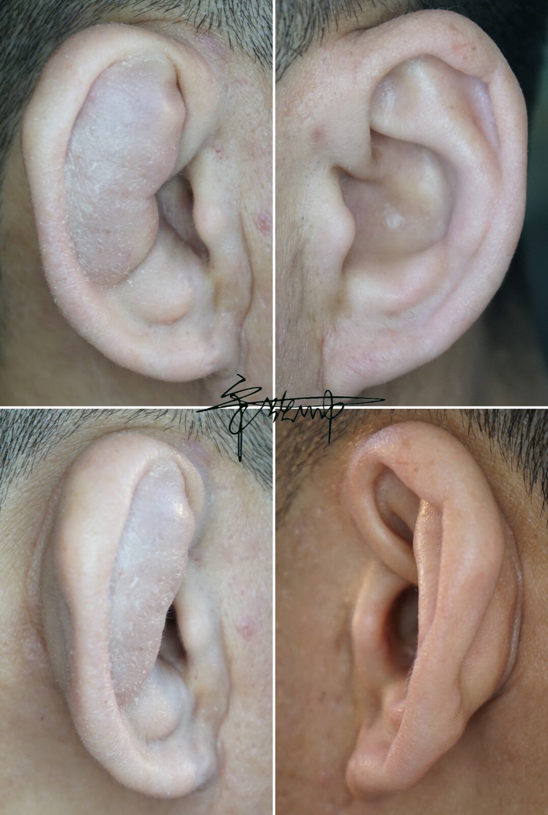 耳廓软骨膜炎怎么治疗图片