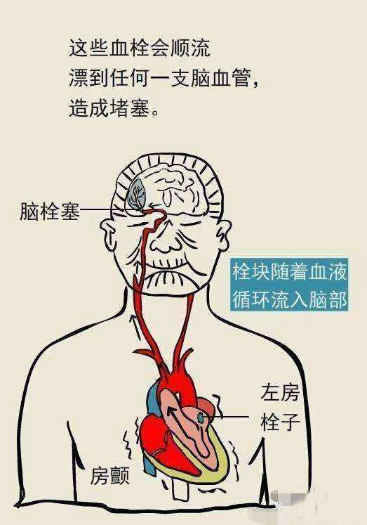 31岁心慌1年，现半身不遂住进了ICU，医生找到元凶：心慌没重视