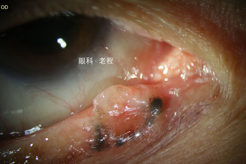 早期的皮脂腺癌可表现为单发性眼睑结节,一般为起源自睑板的质硬结节