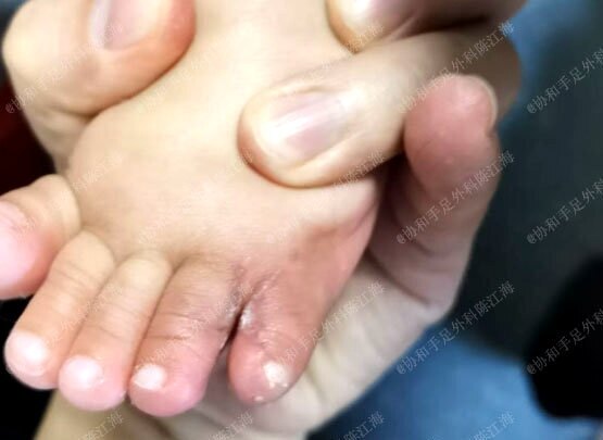 的时候进行手术治疗,在宝宝学习站立和走路之前把并趾分开就可以了