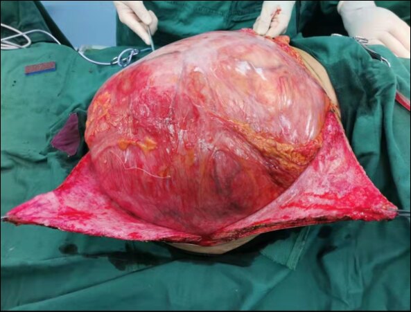 脂肪肉瘤晚期图片