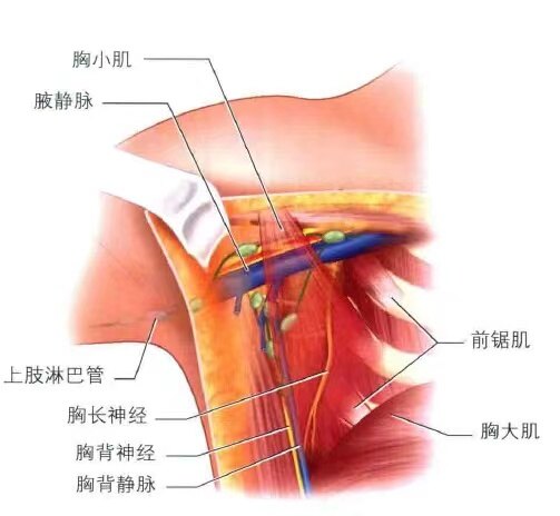 乳腺癌腋窝清扫解剖图图片