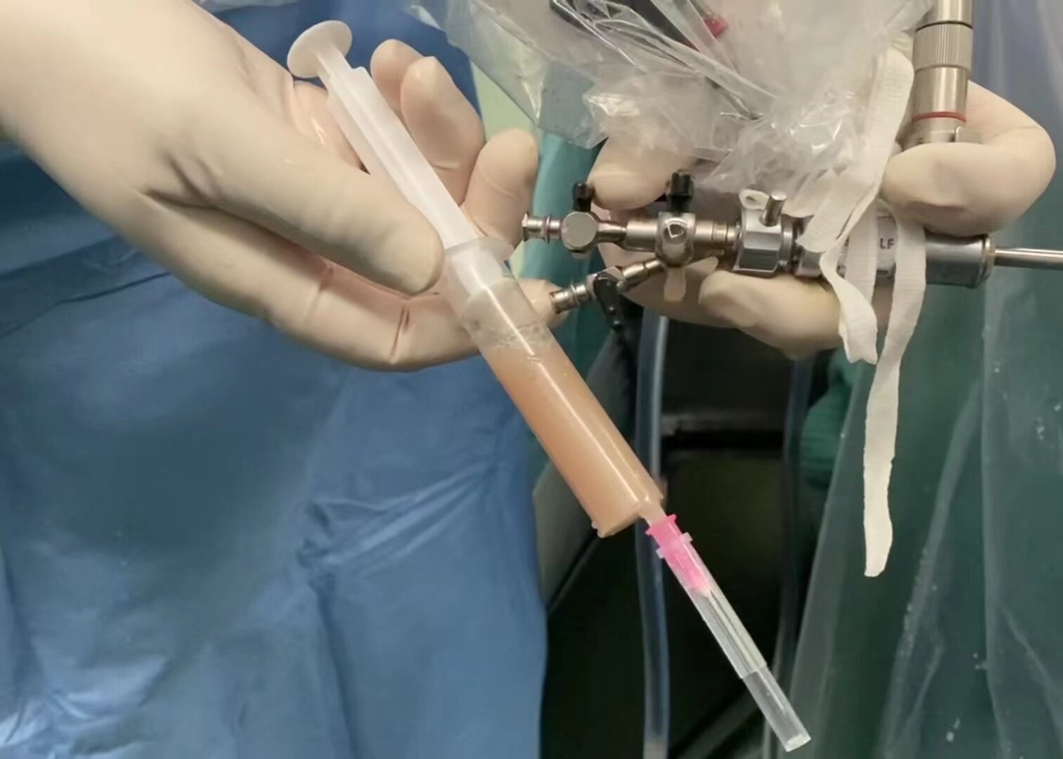 或者输尿管扭曲,先天性纤细这种情况下只能留置支架二期再考虑行手术