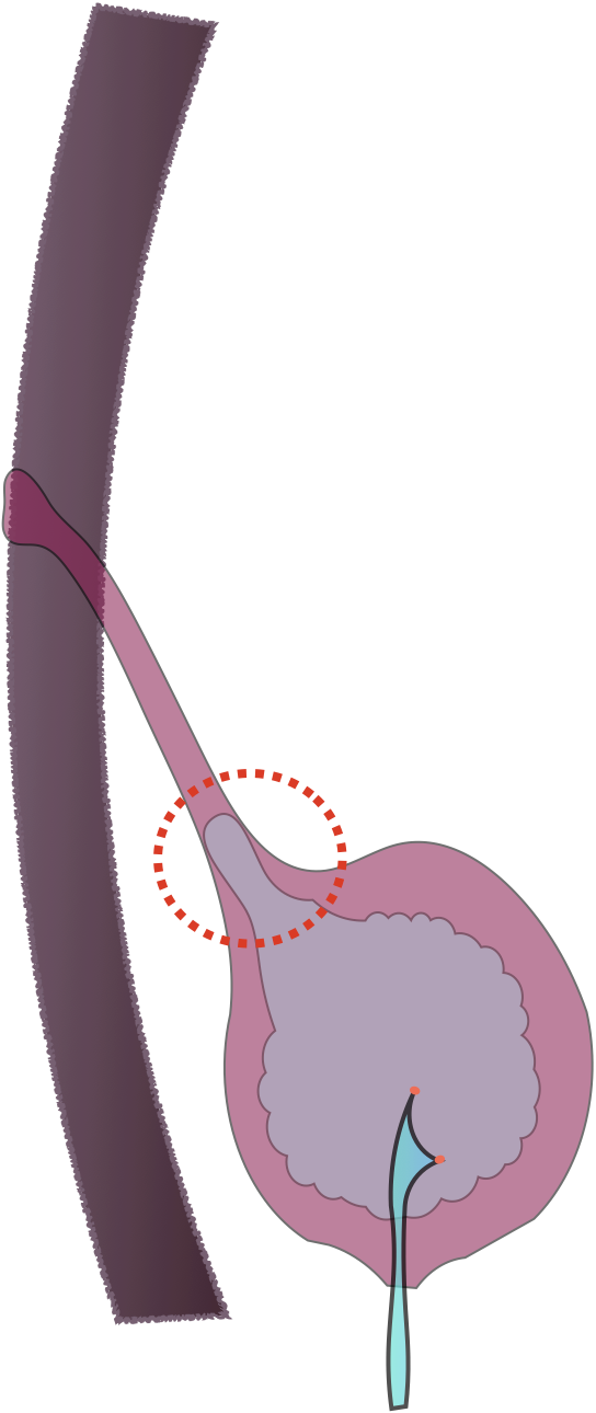 脐尿管位置图详细图片