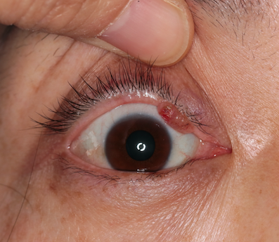 眼睑瘤的症状图片图片