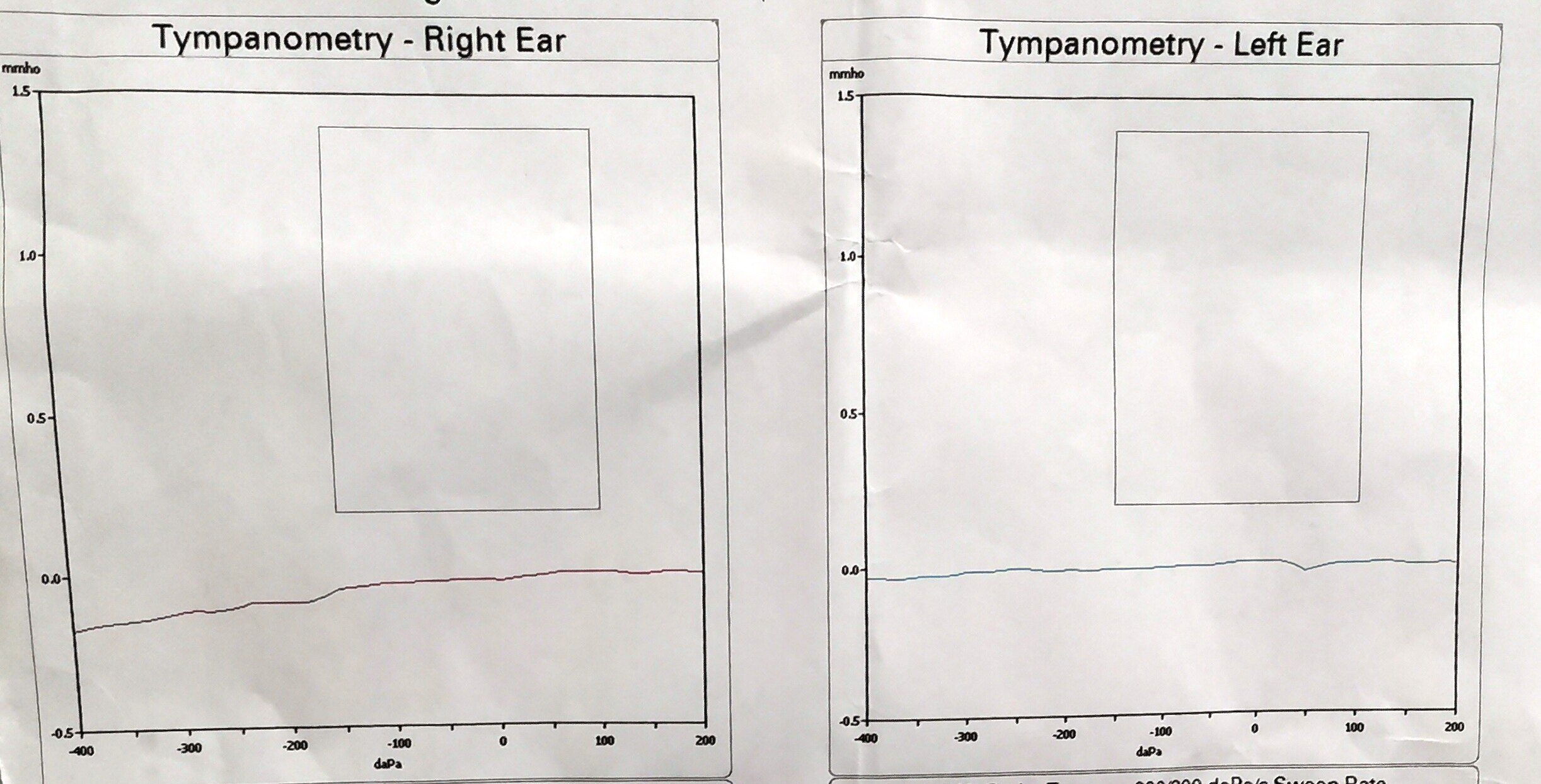 图4 声导抗图对诊断有重要价值,平坦型(b型)为分泌性中耳炎的典型曲线