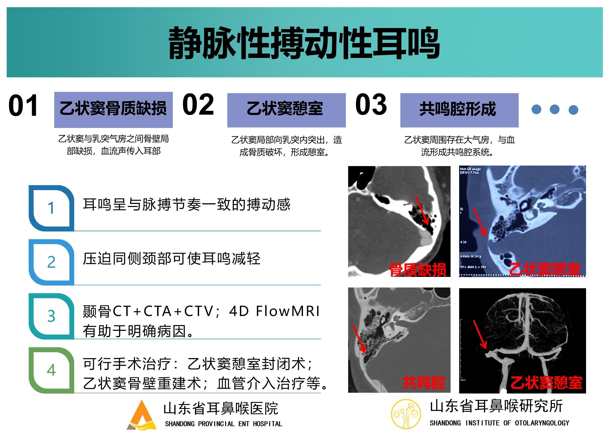 血管搏动性耳鸣