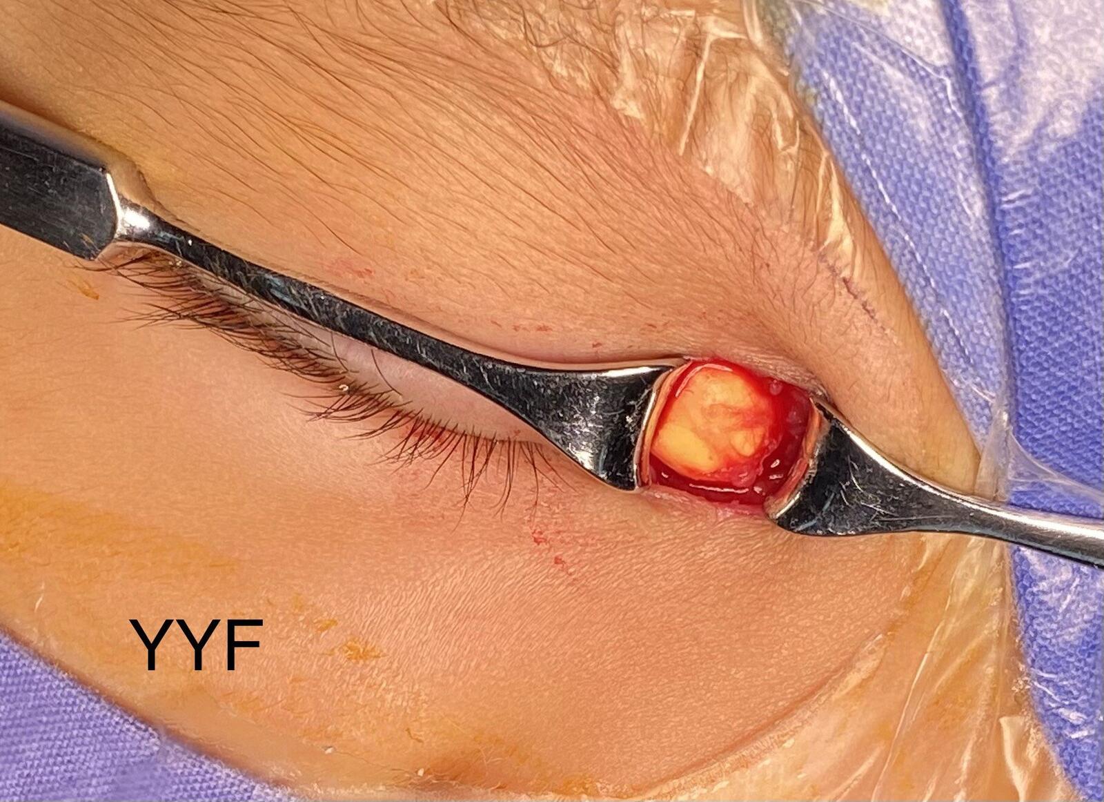 眼眶内上方皮样囊肿的手术治疗&临床上的各类皮样囊肿