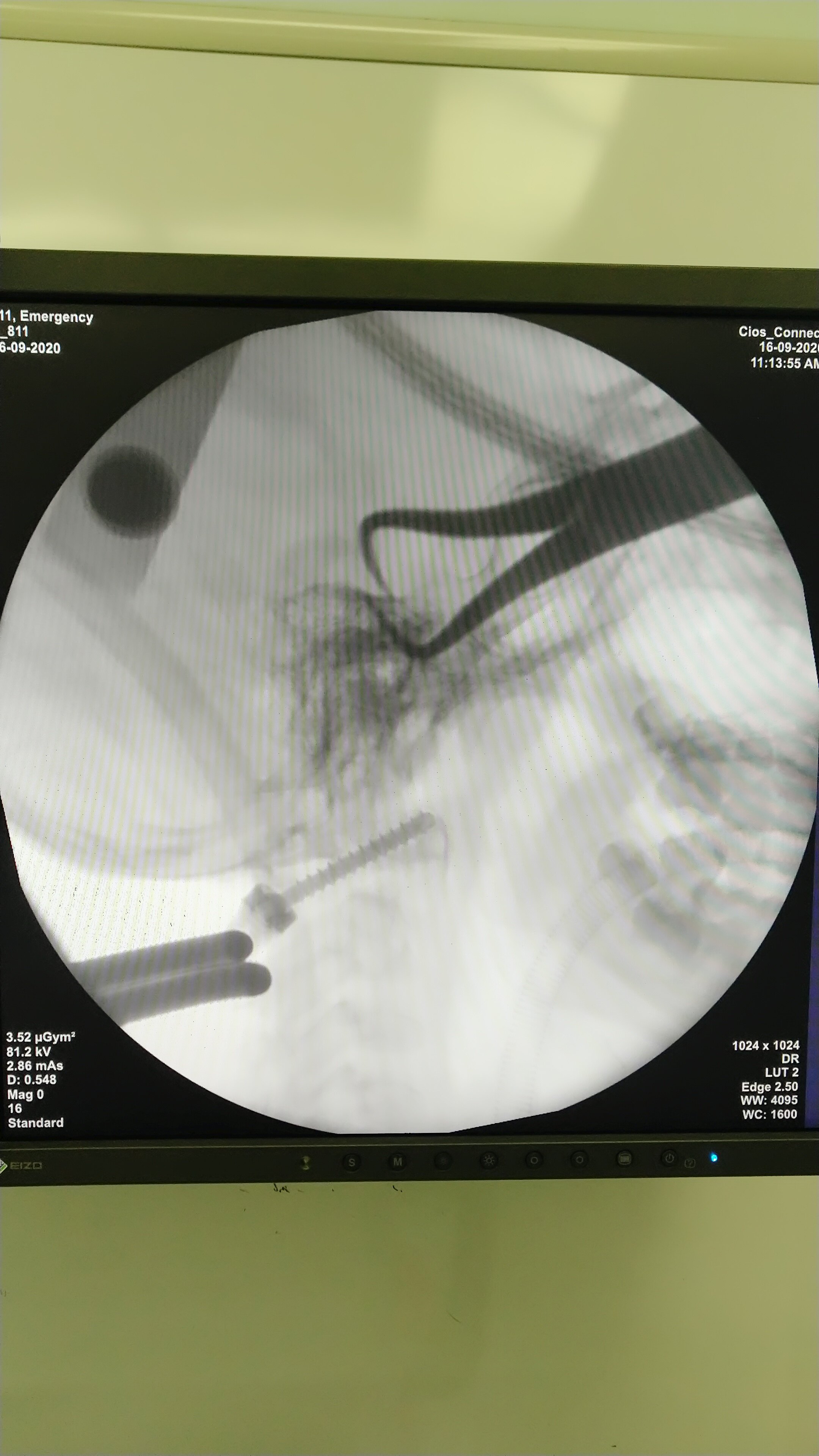 枢椎齿状突骨折手术图图片