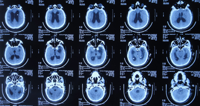 脑动脉瘤术后脑积水,1年5次住院,2次分流术,腰大池引流,ommaya囊抽吸