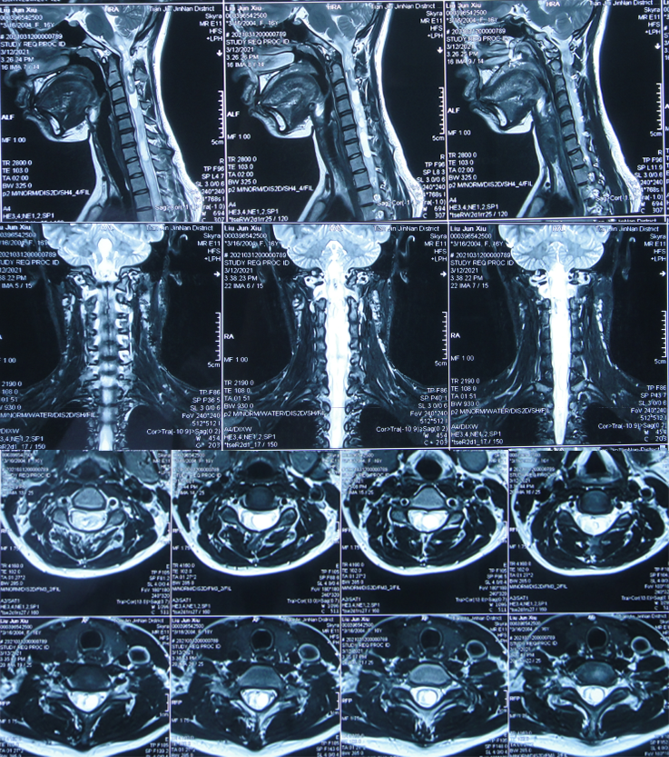 颈椎磁共振正常图片