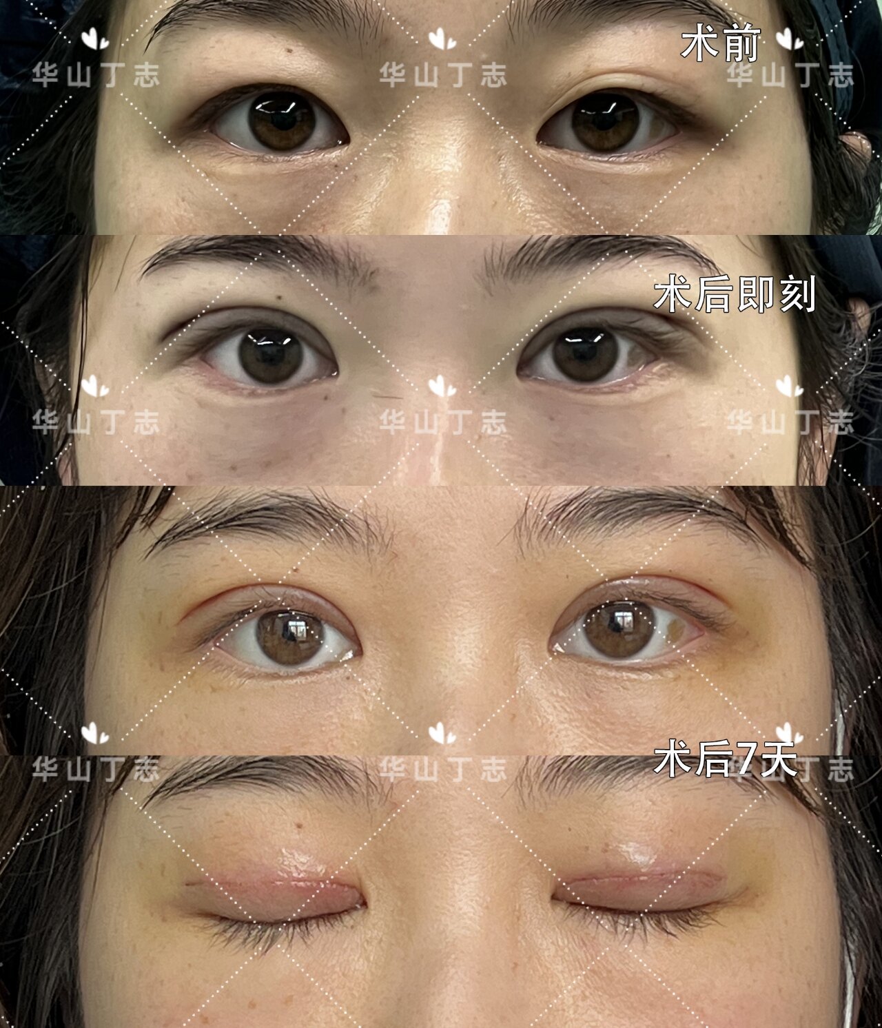 【肿眼泡·全切双眼皮术后7天】_双眼皮手术 - 好大夫在线