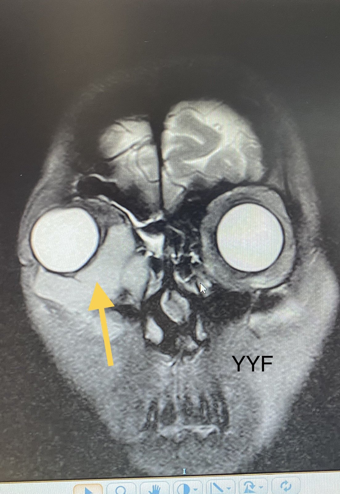 ct显示病变以泪囊区为主,但已经超越泪囊仔细分析疾病的发病特点和