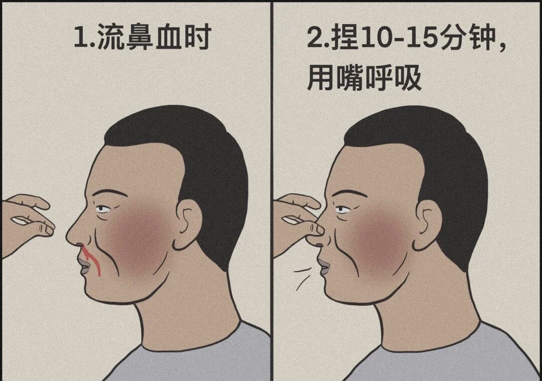 鼻出血的常见原因,部位,止血方式及注意事项_鼻出血_鼻出血介绍 - 好