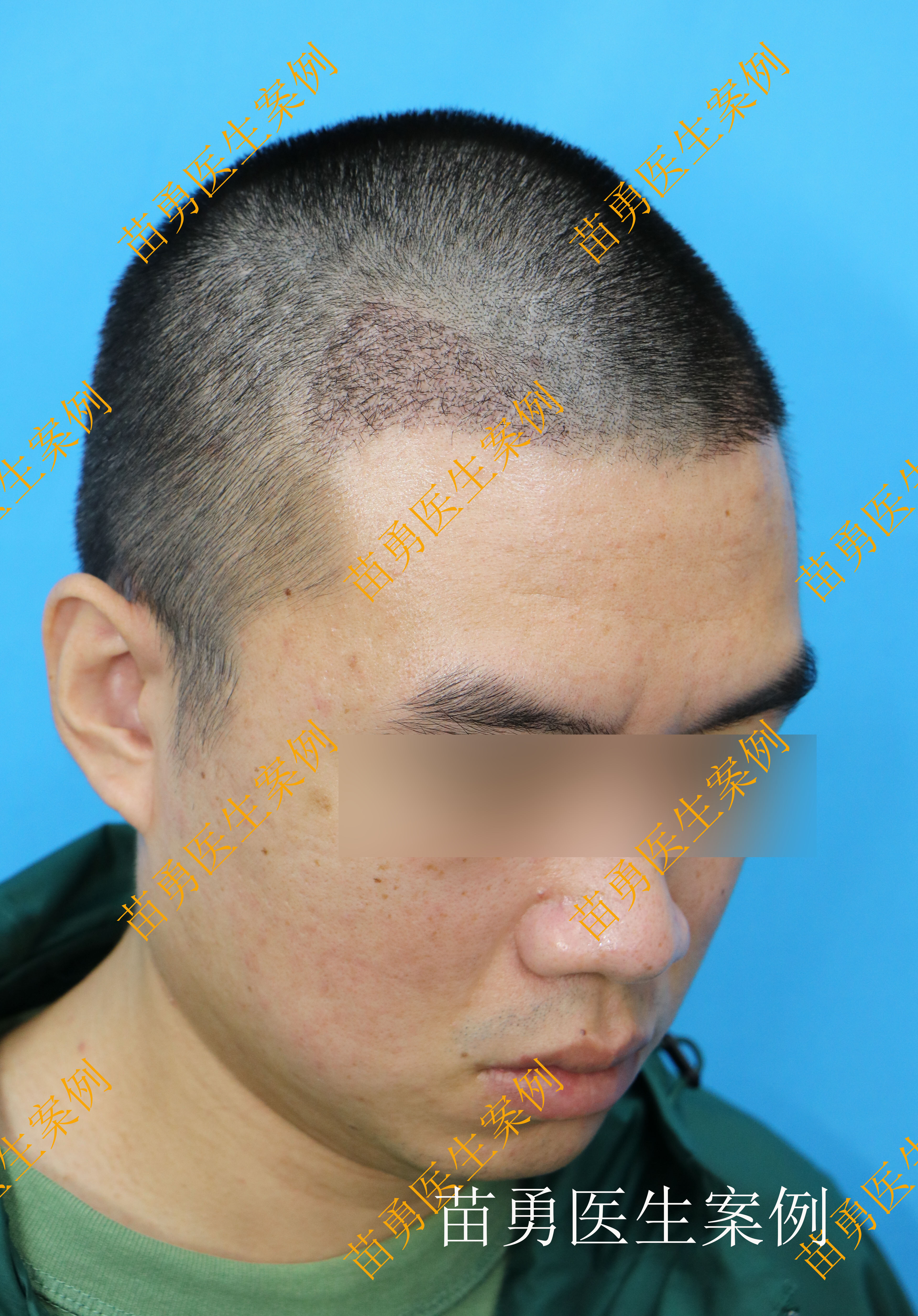 【植发案例14|男性双侧额角】_植发_植发治疗介绍 - 好大夫在线