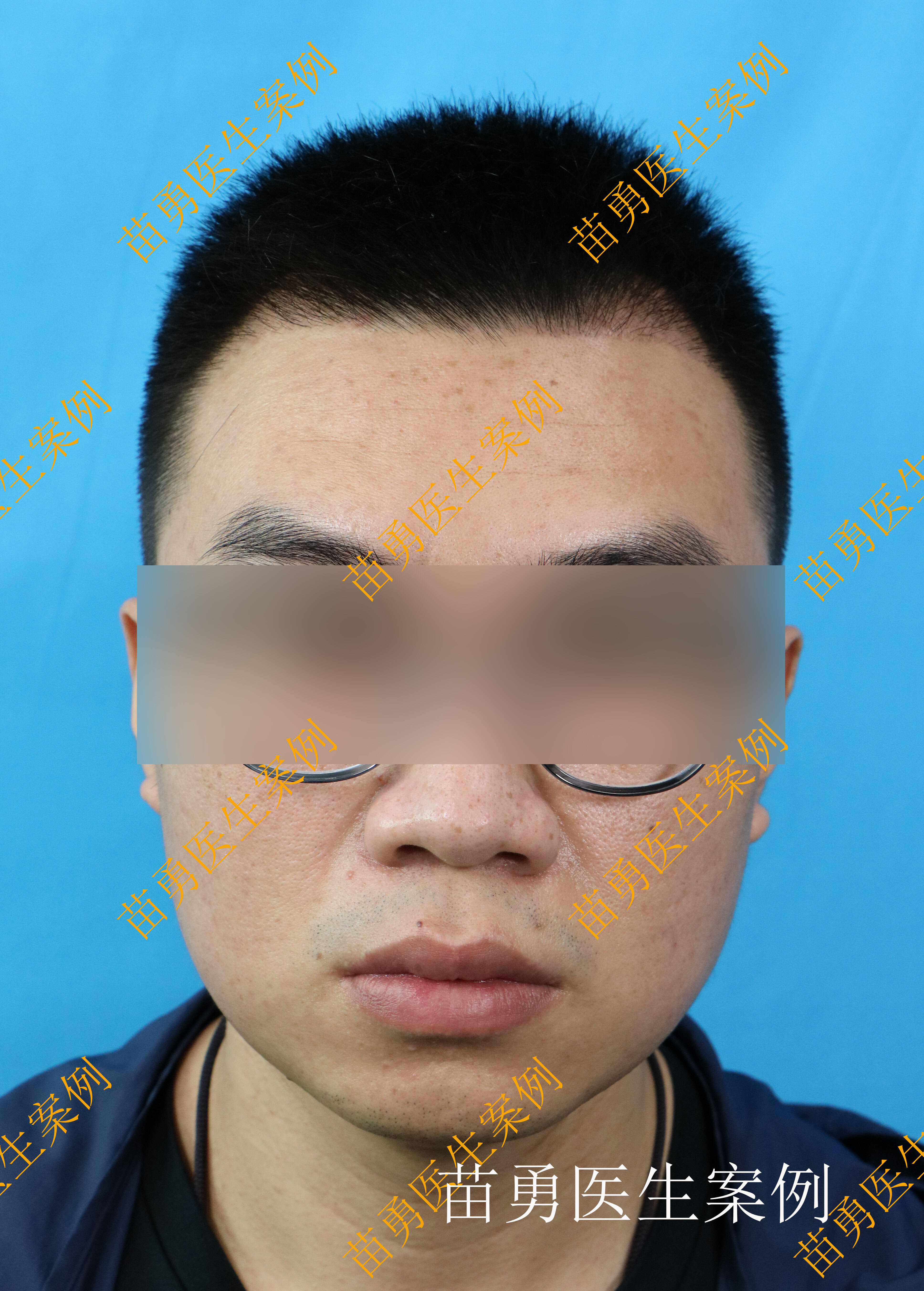 新生男人植发(男生植发生长过程记录)