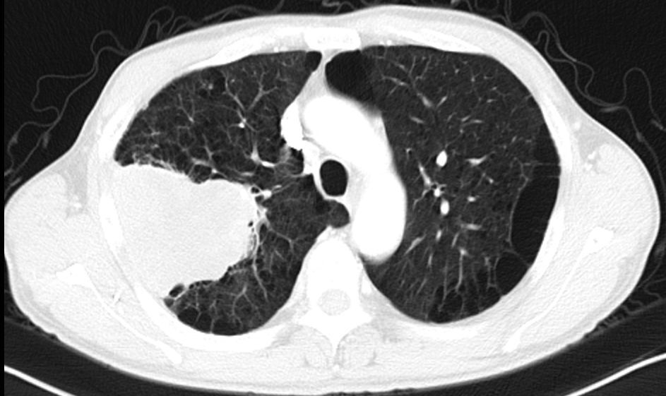 alk肺癌的影像学表现