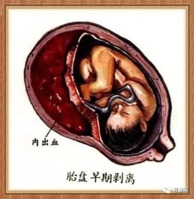 绒毛膜下血肿 一个让人揪心的事儿 好大夫在线