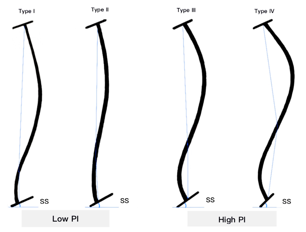 胸腰椎后凸( thoracolumbar kyphosis,tlk),腰椎前凸(lumbar lordosis