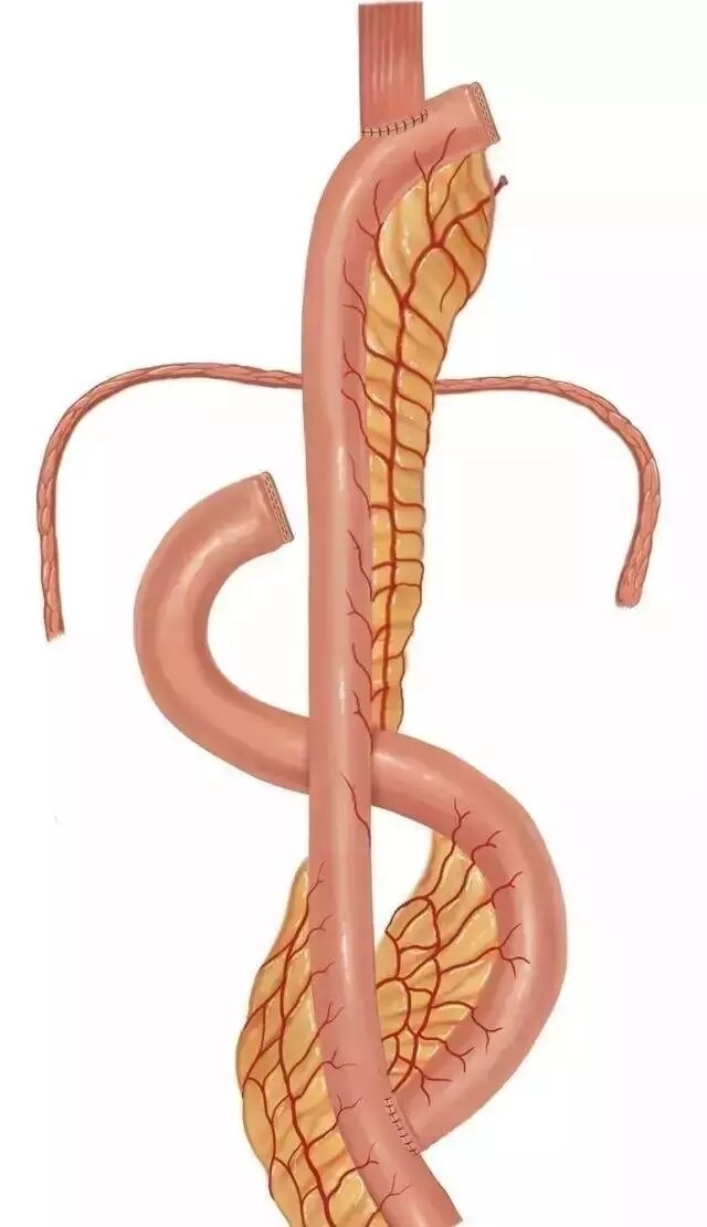 全胃切除后,没有胃,怎么办?
