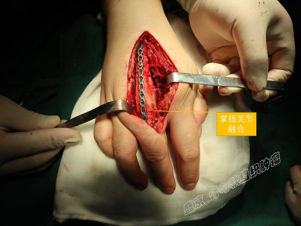 掌骨骨巨细胞瘤诊断及手术治疗_骨巨细胞瘤_骨巨细胞瘤治疗方式 - 好