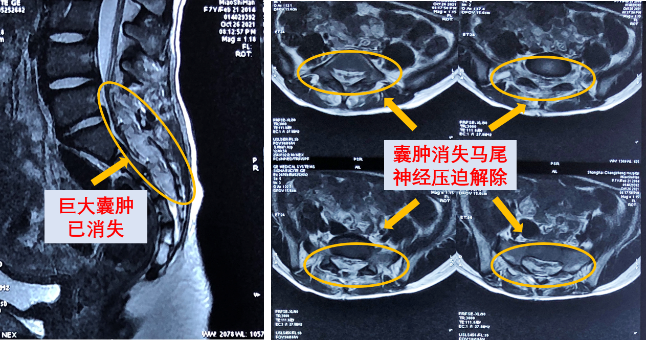 尾骨囊肿图片图片