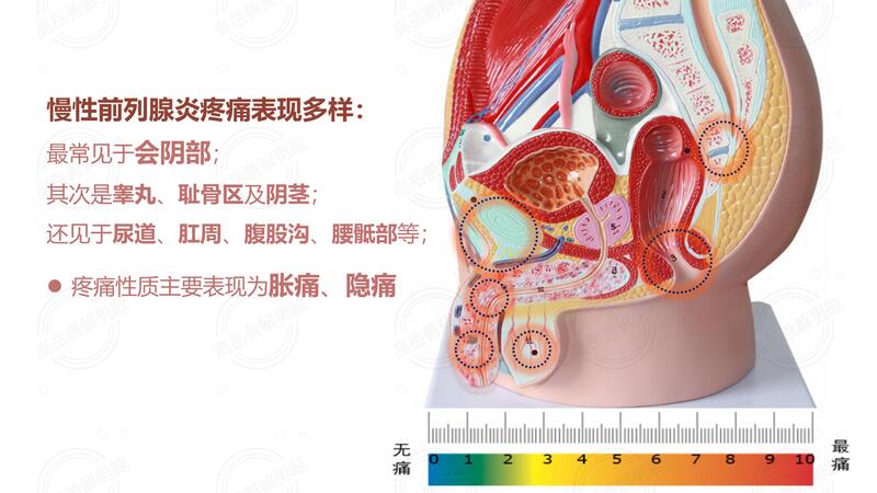 图：前列腺炎肌痛症状.jpg