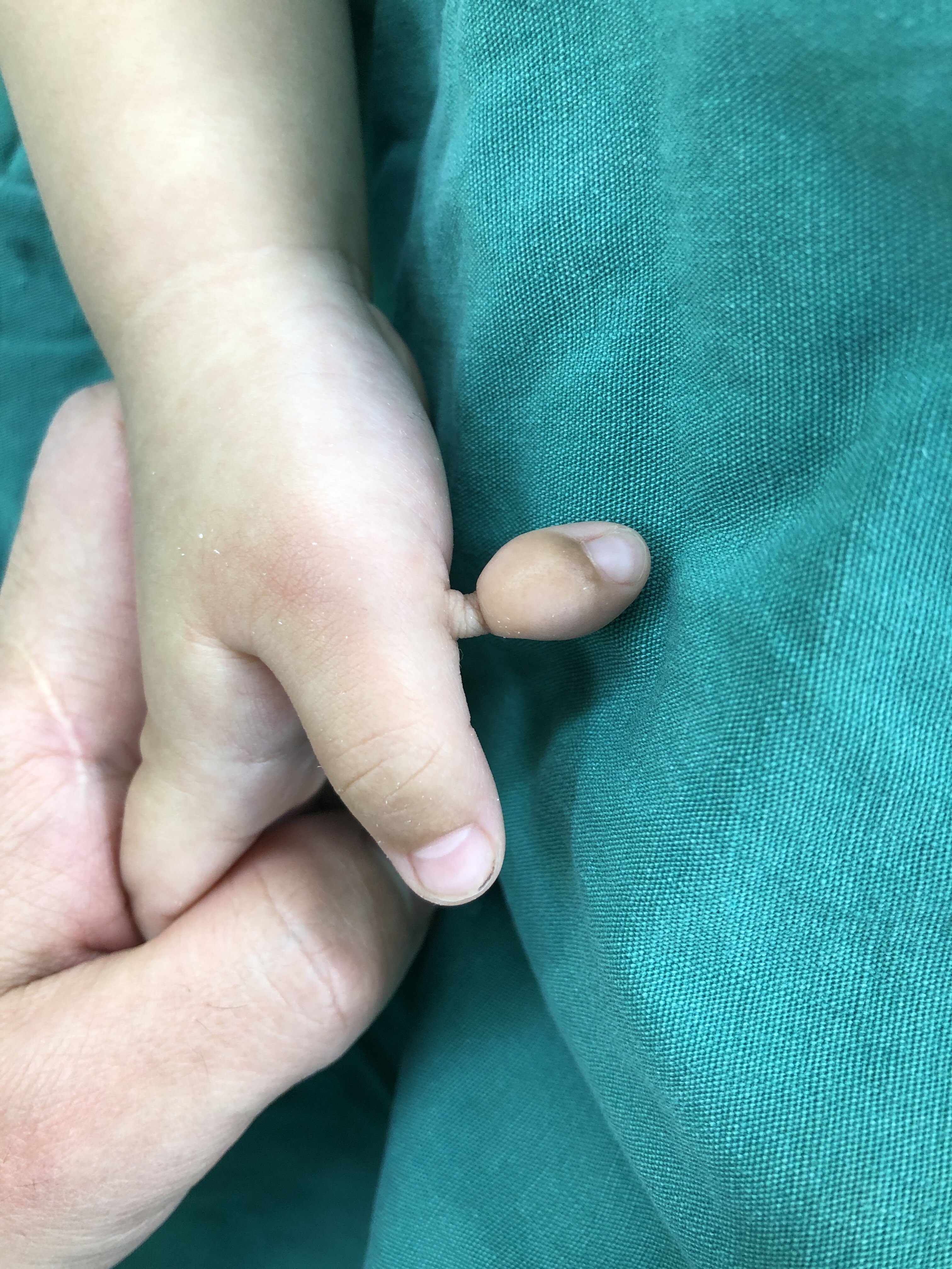 肉赘型多指,禁止用线节在根部捆扎,正确方法是"环根部完整切除术"!