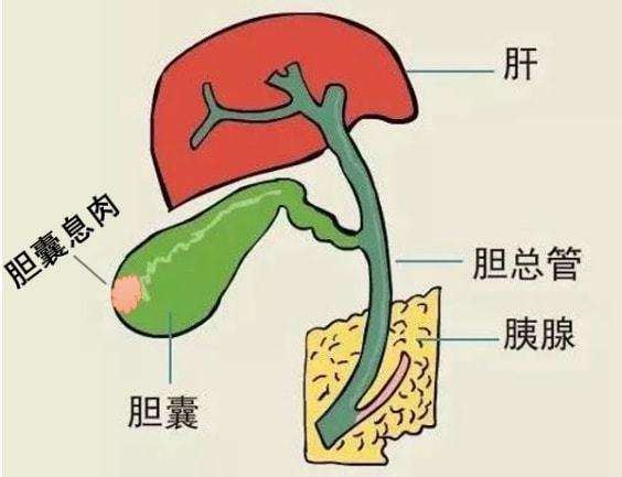 胆囊息肉相关的几个问题