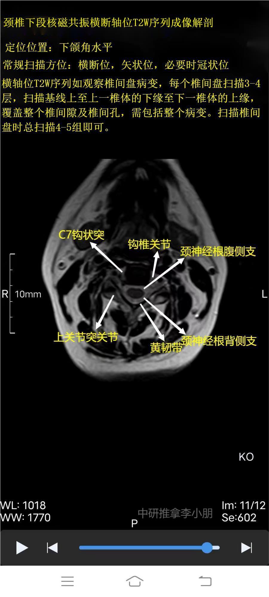 颈椎磁共振图片详解图片