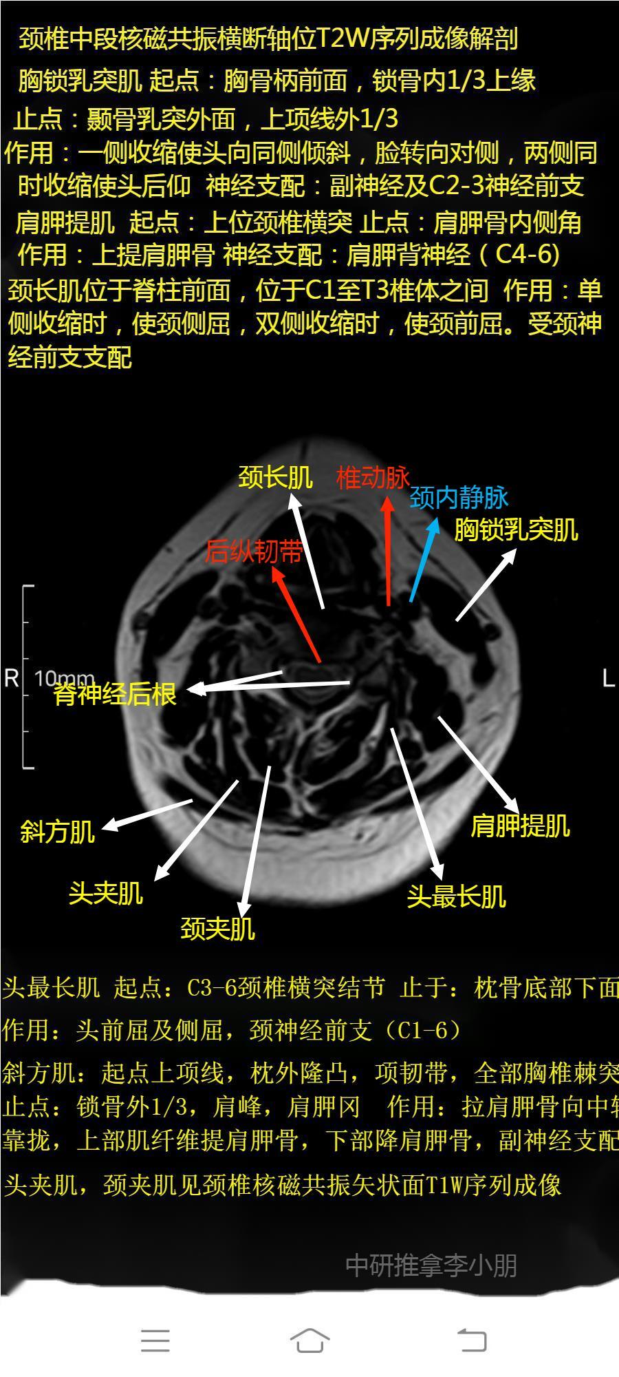 颈椎磁共振图片详解图片