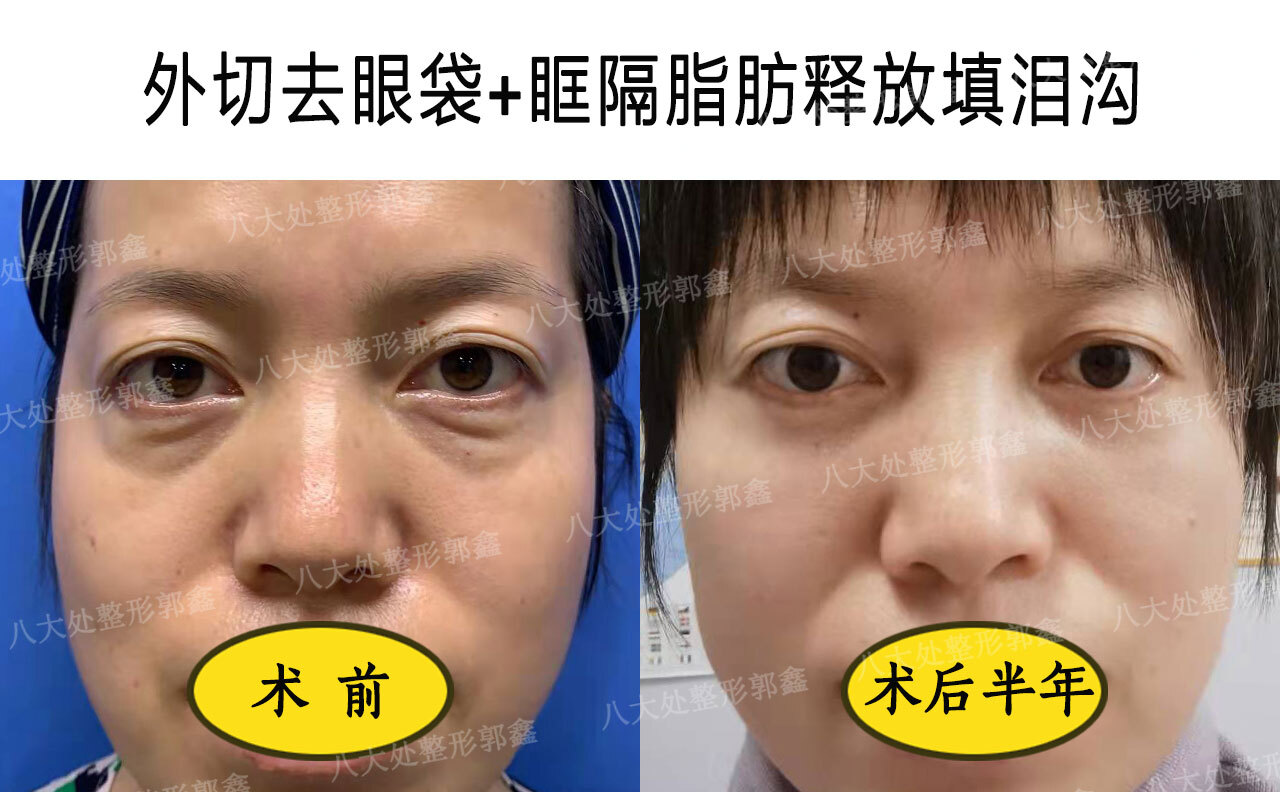 去眼袋眶隔脂肪释放中内固定的优势 - 好大夫在线