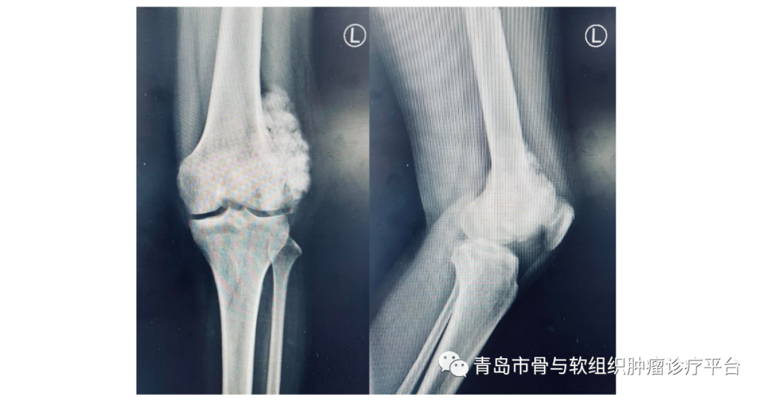 典型病例膝關節原發惡性骨腫瘤一期手術切除腫瘤型膝關節假體置換