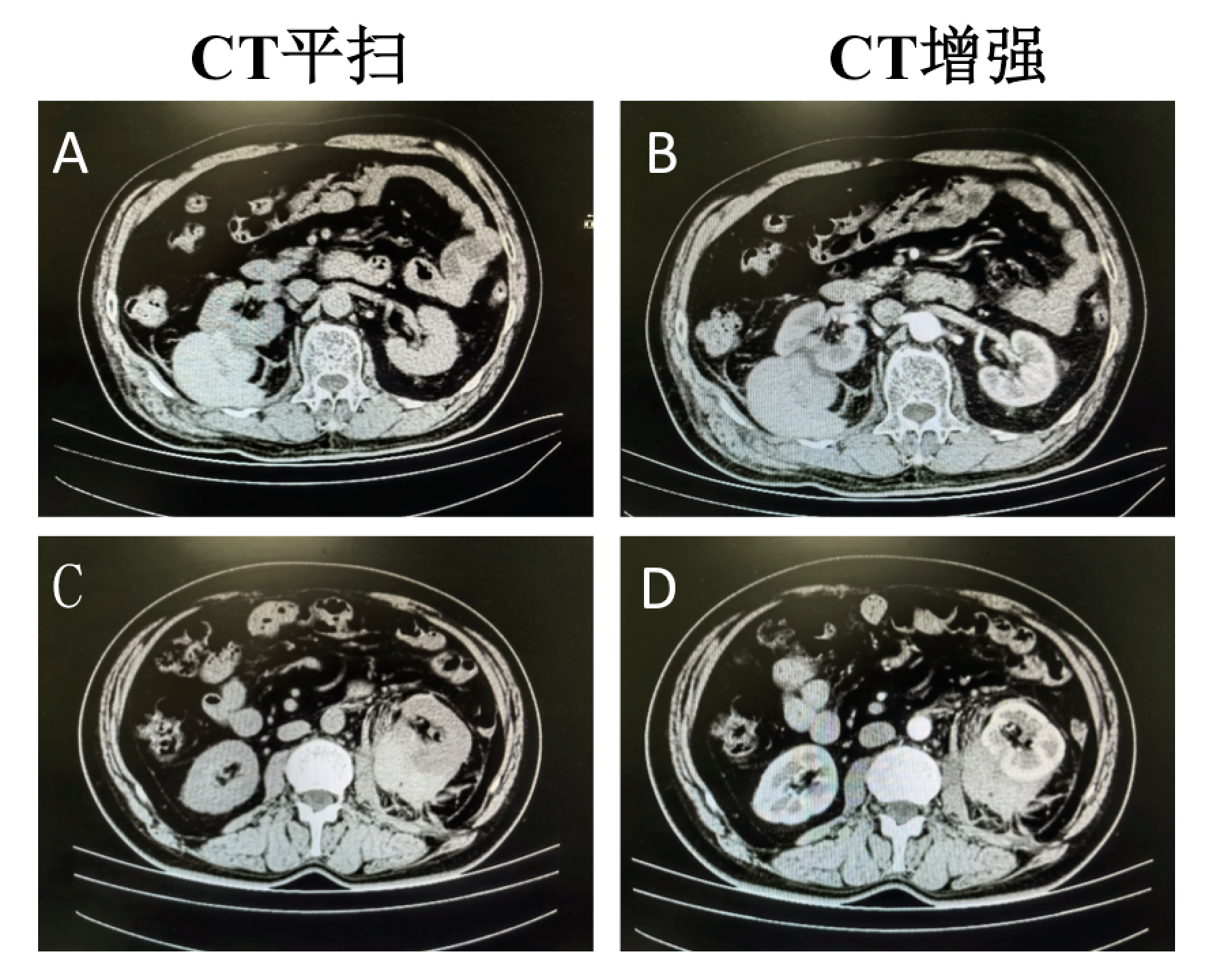连续两例肾挫裂伤—都是电动车惹的祸!
