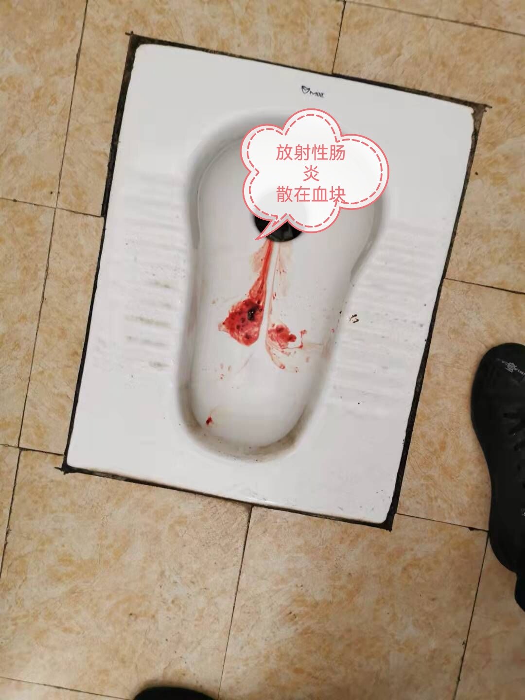 脓血便常见于图片