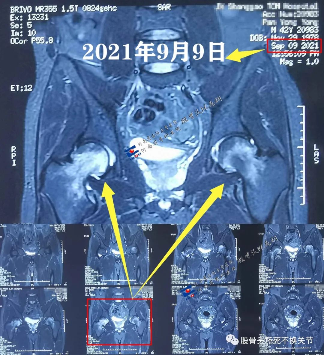 险些被"砍头"的股骨头骨髓水肿综合征 - 好大夫在线